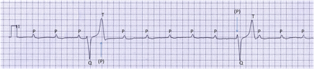 Trouble de la conduction, pacemaker